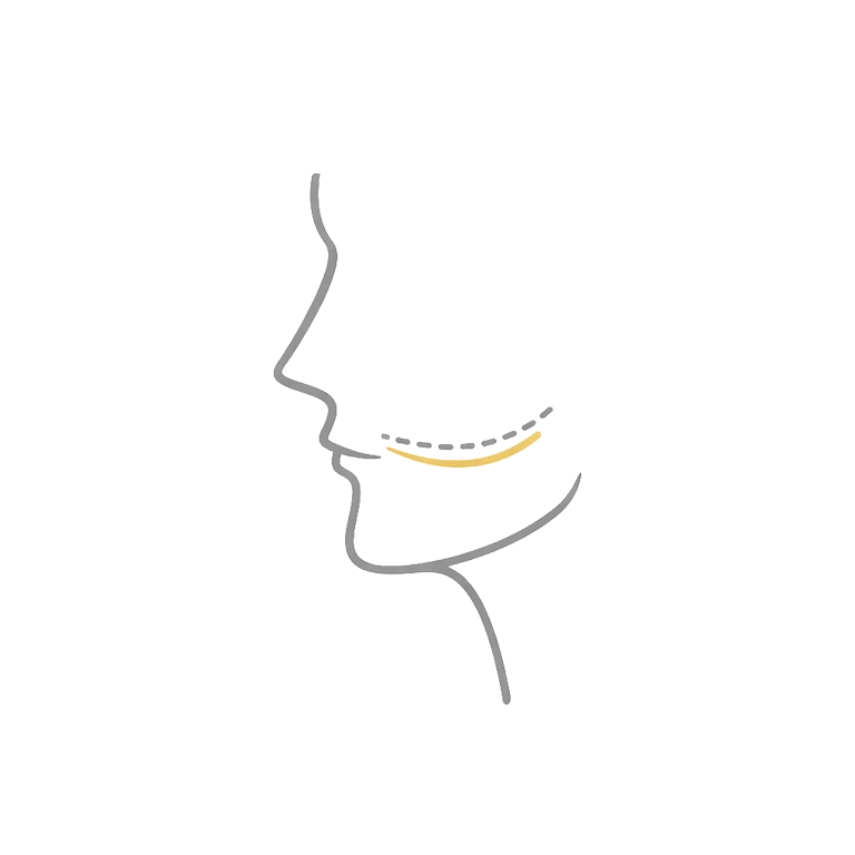 Augenringe Unterpritzung: Volumenverlust